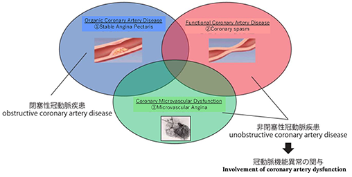 Three mechanisms of myocardial ischemia in angina pectoris