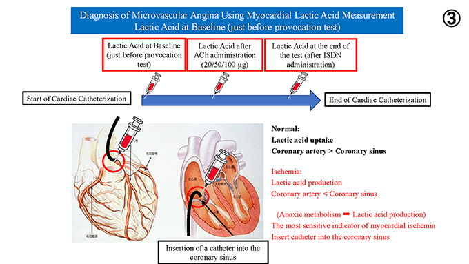 図8 心筋乳酸測定による微小血管狭心症の診断